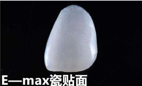 烤瓷牙相比，全瓷牙和纯钛烤瓷牙哪个性价比更高？了解区别，再做选择！