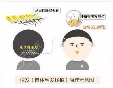 天津总医院植发效果好吗?