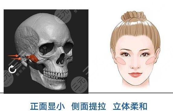 颧骨磨骨是什么？