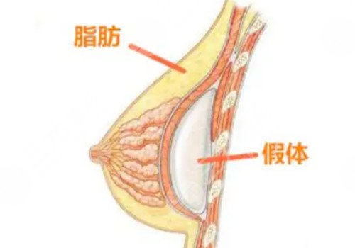 光面假体和毛面假体的优缺点