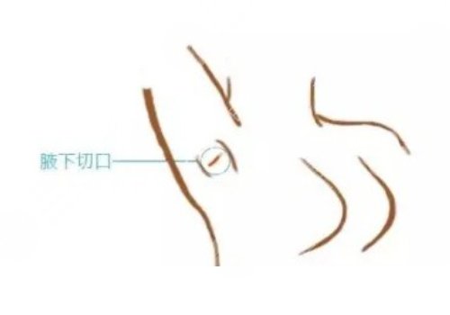 腋下切口隆胸优缺点