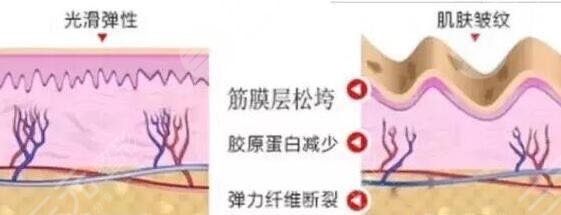 热玛吉四代900发和1200发的区别