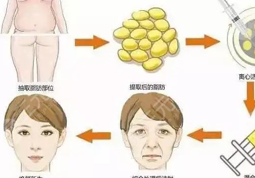脂肪填充面部多久恢复好？