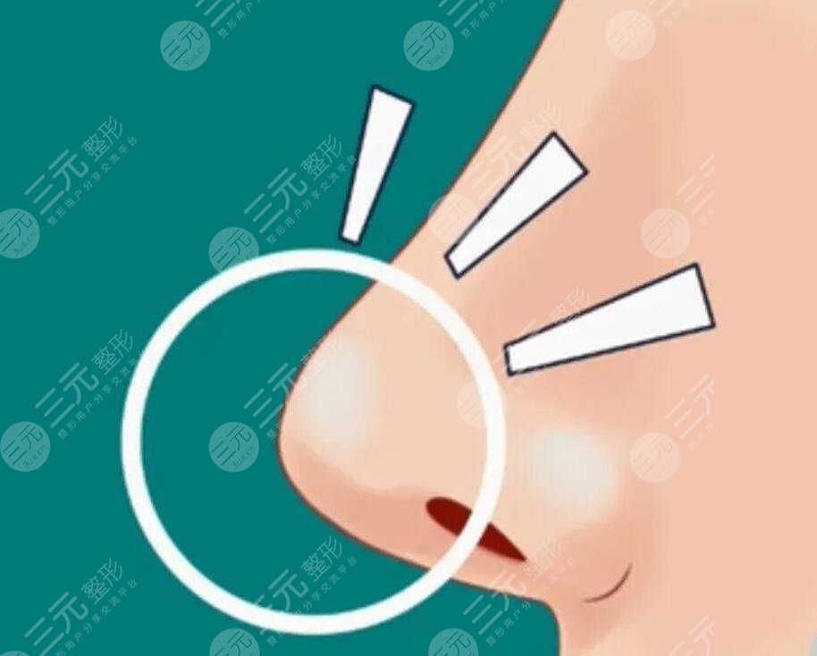 如何让鼻头变小方法？手术方法效果理想，项目定价收费情况