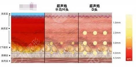 超声炮做一次能维持多长时间