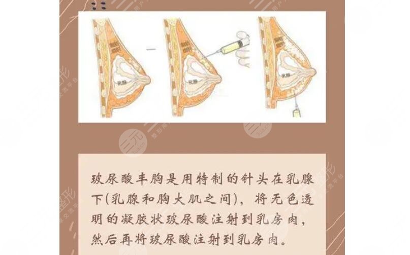 玻尿酸隆胸从a到b需要几只？