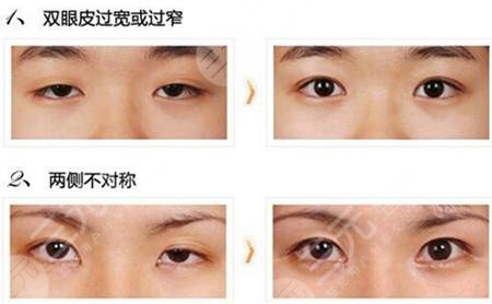 双眼皮修复大概多少钱呢？