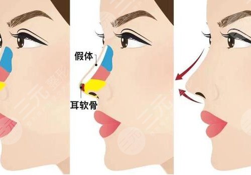假体隆鼻整形费用大概多少？