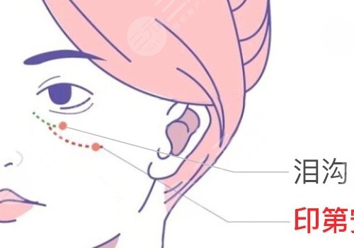泪沟填充后淤青要多久才能恢复？