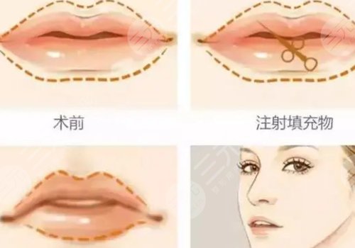 娇兰玻尿酸填充哪里好？