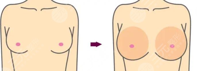 闪耀假体隆胸怎么样？