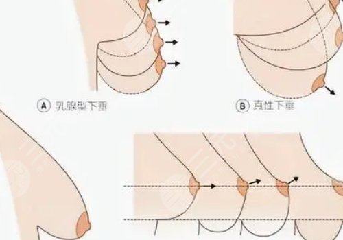 乳房悬吊术可以维持多久？