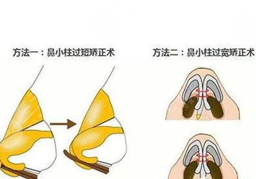 鼻小柱歪斜怎么修复？
