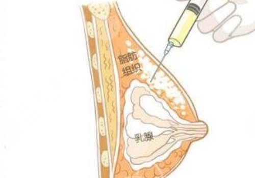 玻尿酸丰胸可以保持多长时间？