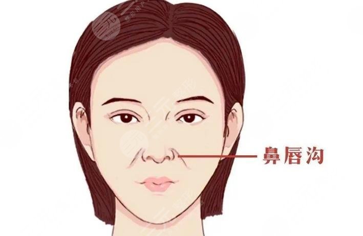 鼻基底填充和法令纹填充的区别在哪？