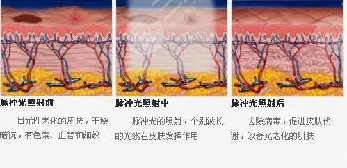 镭射净肤的注意事项有什么？