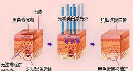 光子嫩肤几天见效啊?