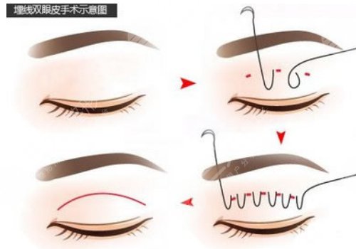 双眼皮手术有几种做法?
