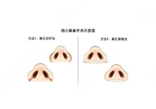 整鼻子鼻翼缩小多少钱？有后遗症吗？