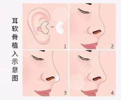 耳软骨隆鼻缺点有哪些?