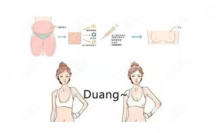 脂肪丰胸手术一般多少钱?