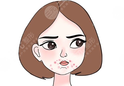 脸上长痘印怎么办