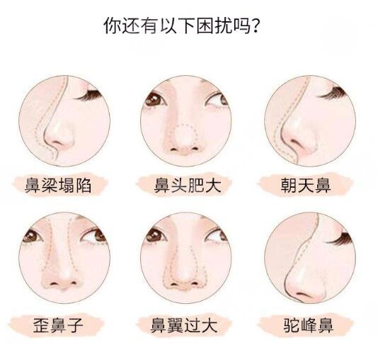 假体隆鼻恢复时间要多久?