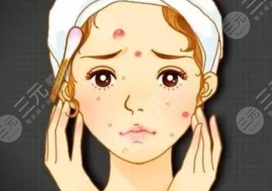 痤疮