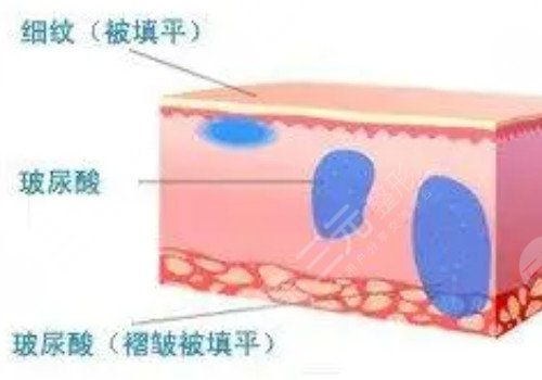 脸上皱纹怎么去除?