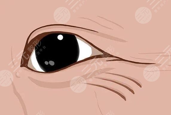 去除眼下皱纹做什么医美项目好？做好除皱的注意事项，果自然事半功倍~