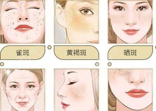 治疗色斑需要注意的事项有哪些?