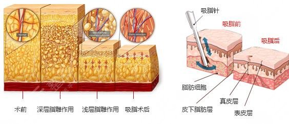怎样减手臂上的肉有?