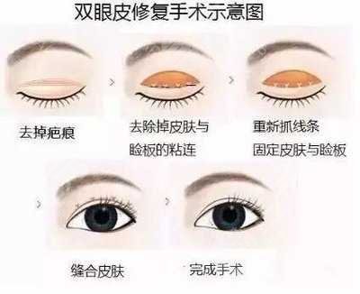 失败双眼皮修复大概需要多少钱?
