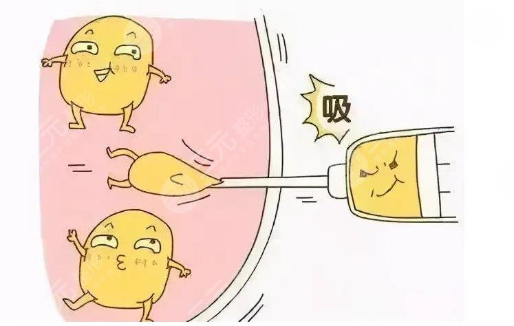 吸脂减肥怎么样?有哪些方法?(4