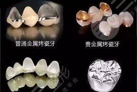 钛合金烤瓷牙