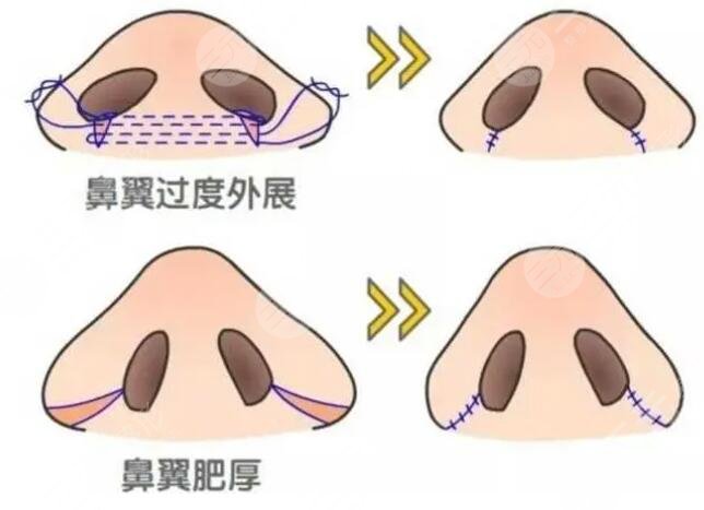 鼻头缩小手术对比