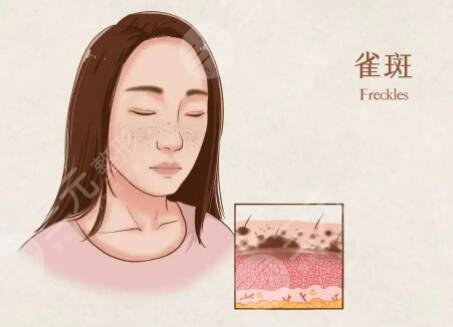 蜂巢激光祛斑果怎么样？治疗原理带你好好探查！术前做到知根知底！