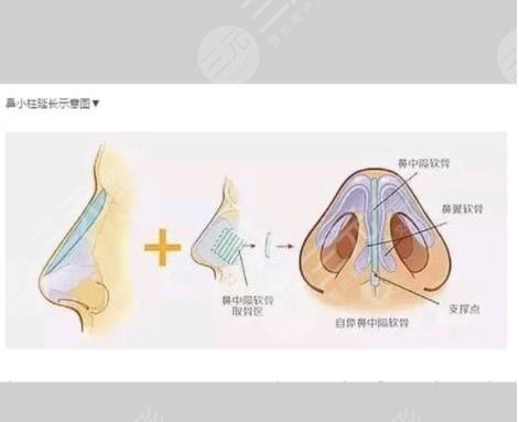 自体软骨隆鼻