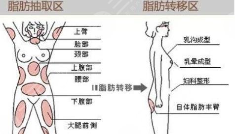 抽脂